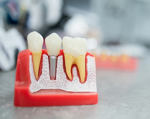 Nova técnica acelera testes de materiais para implantes dentários
